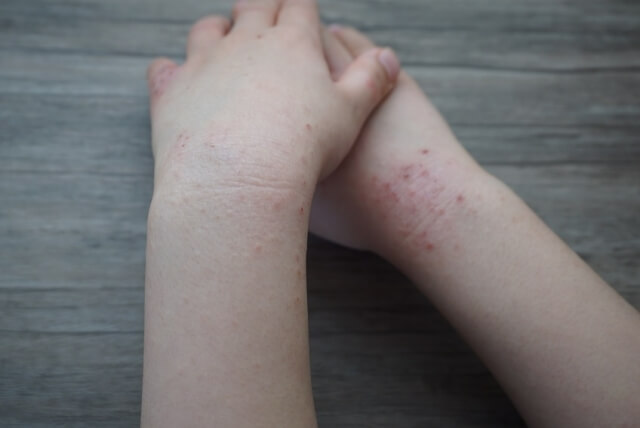 【子どものアトピー性皮膚炎にお悩みの方】|原因や気をつけることを解説