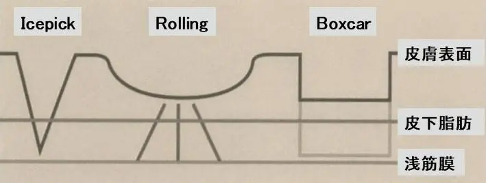 クレーター 瘢痕(萎縮性瘢痕)