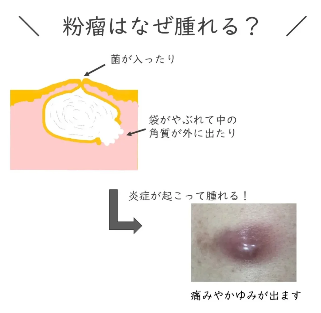 粉瘤はなぜ腫れる？