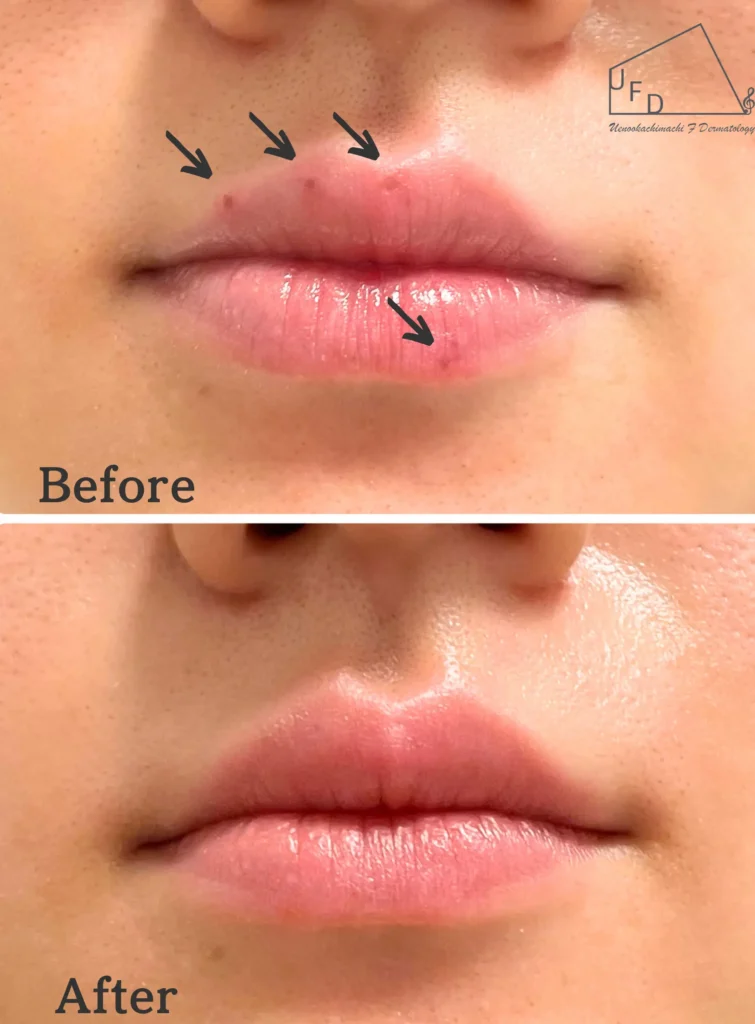 唇のシミ(口唇メラノーシス)