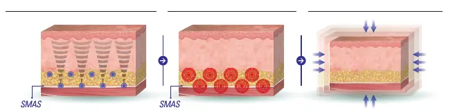 ハイフ ウルトラセルQプラス