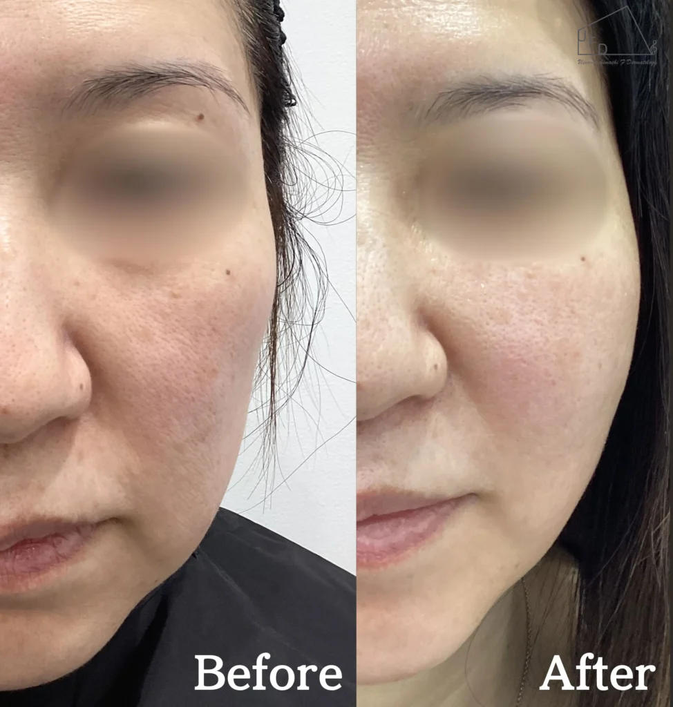 口横のたるみの改善