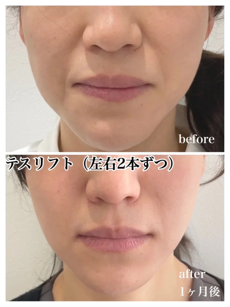 フェイスラインの改善