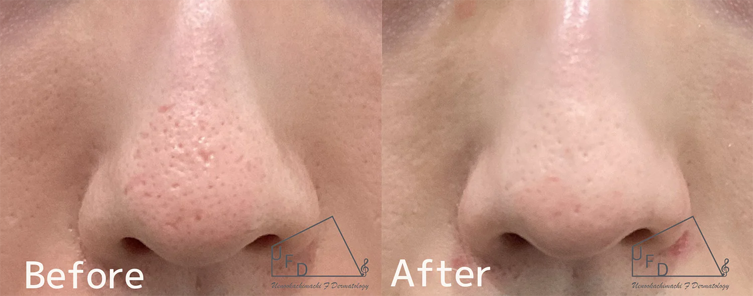 TCAクロスの症例1
