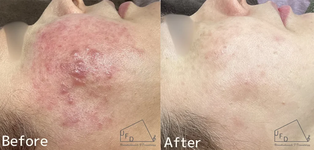 酒さ 赤ら顔の症例写真(治療前後)