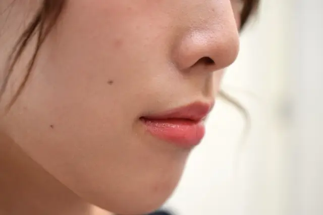 顔のほくろ画像