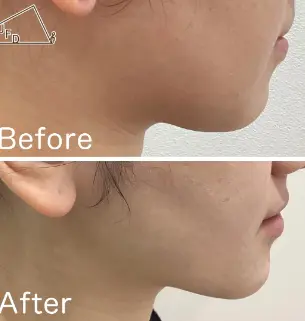 ハイフ施術事例1