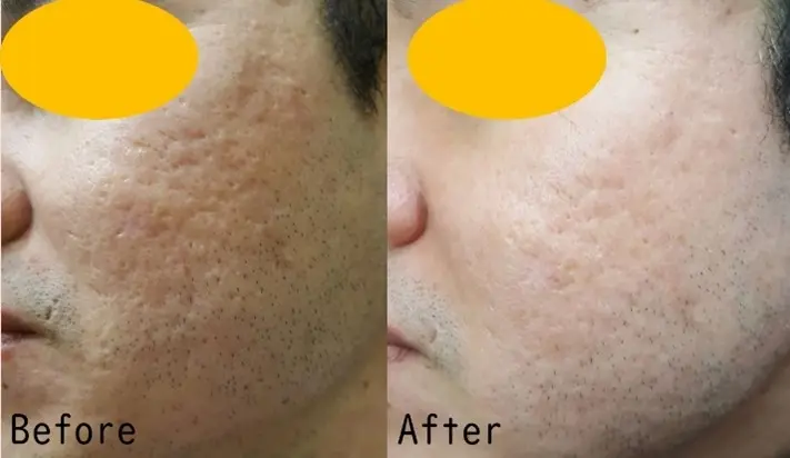 ジュベルックの症例4