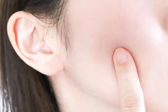 ニキビダニの画像