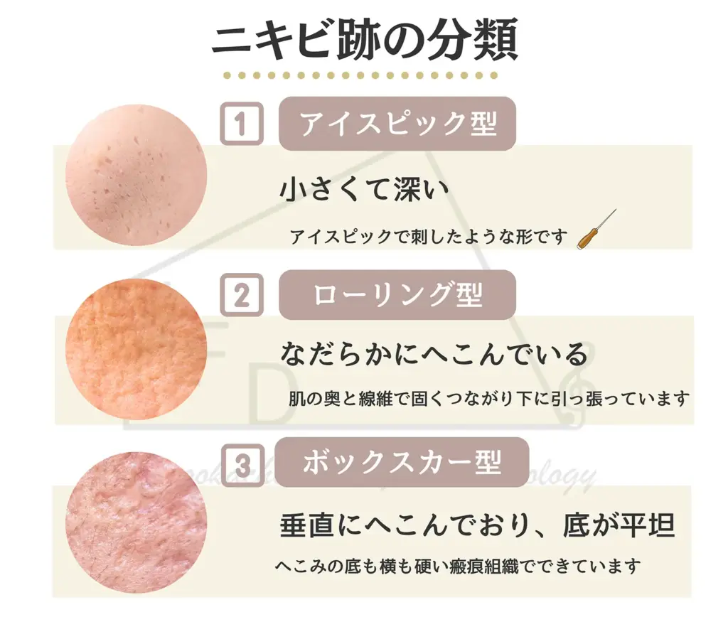 ニキビ跡の分類