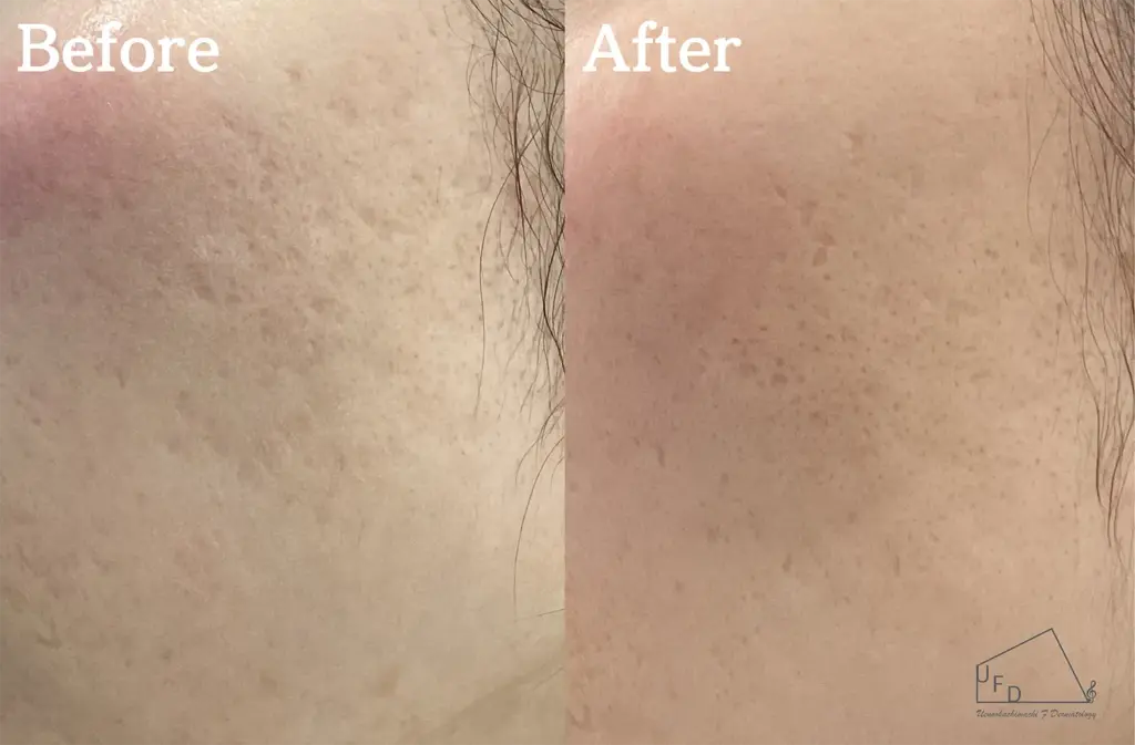 サブシジョン症例3