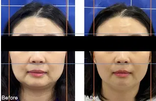 ポテンツァ施術事例(Jeisys社提供)