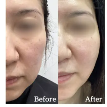 糸リフト施術事例1