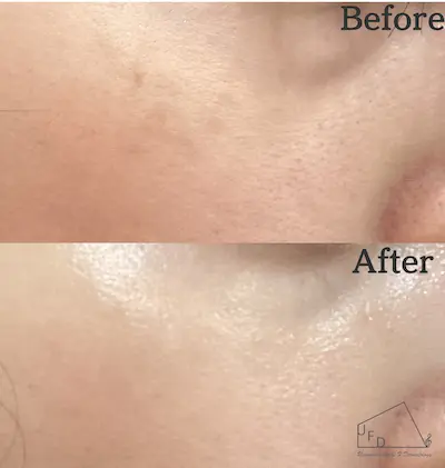 Qスイッチルビーレーザー症例