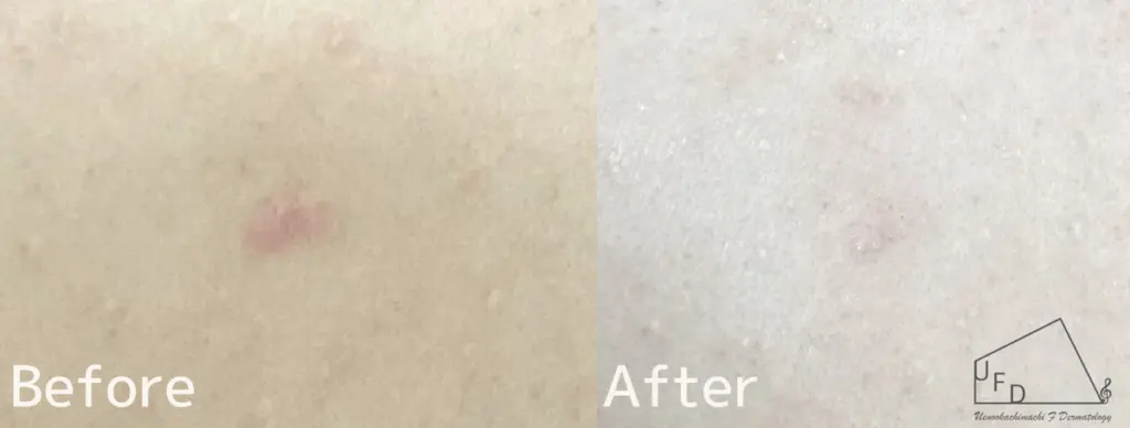 Vビームコラム自費症例2