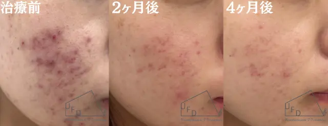 イソトレチノイン症例1