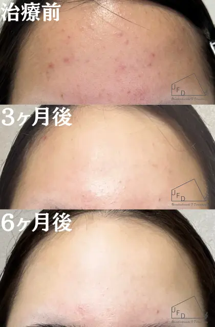 イソトレチノイン症例3