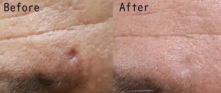 ジュベルックの症例2