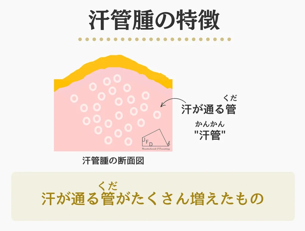 汗管腫の特徴