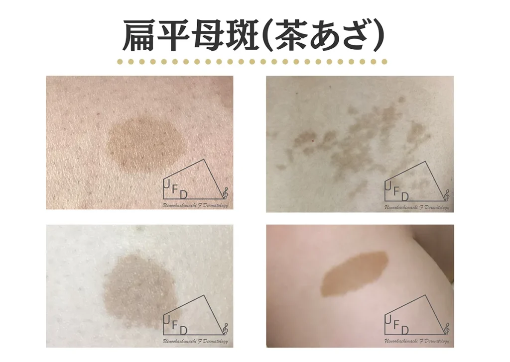 扁平母斑（茶あざ）