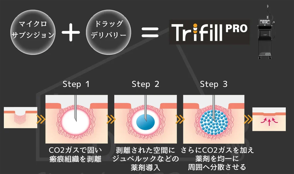 トライフィルプロの解説