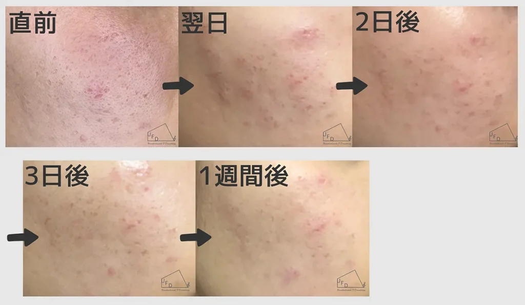 ダウンタイムの症例