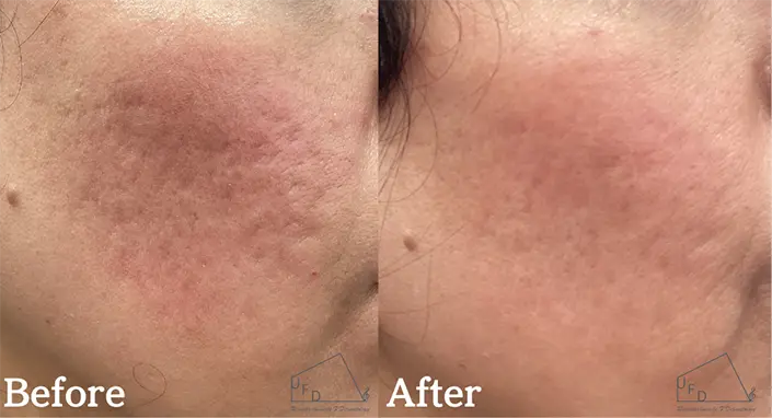 サブシジョン症例2