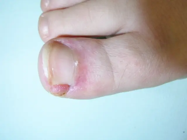 陥入爪の症状