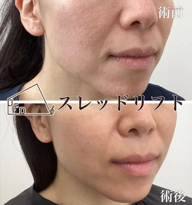糸リフト症例1