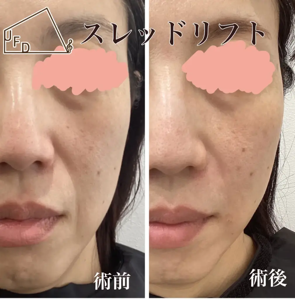 糸リフト症例3