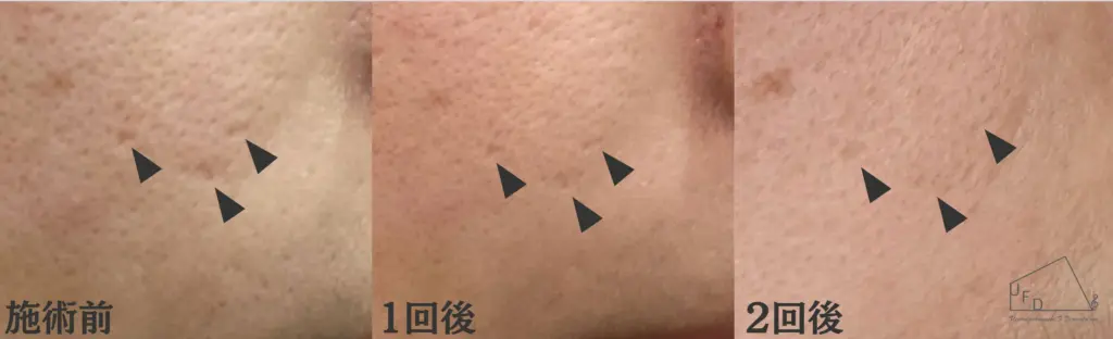 トライフィル症例