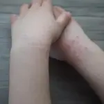 【子どものアトピー性皮膚炎にお悩みの方】|原因や気をつけることを解説