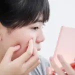 ニキビ跡の治療に効果のあるTCAクロスとは