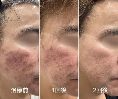 当院の症例 【50歳代男性】頬の赤み改善(2回実施)