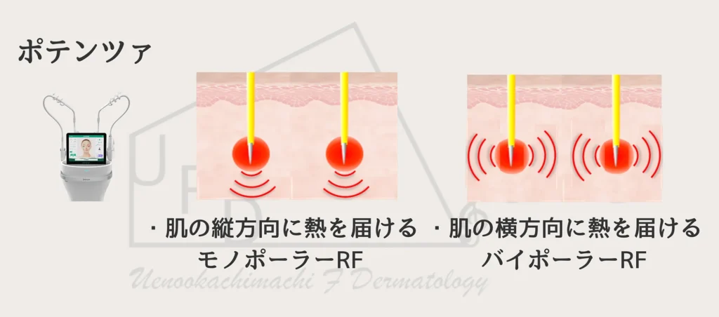 ポテンツァの仕組みについて写真付きで解説します •	モノポーラRFとバイポーラRFというチップを使い分けて様々なお悩みにアプローチします