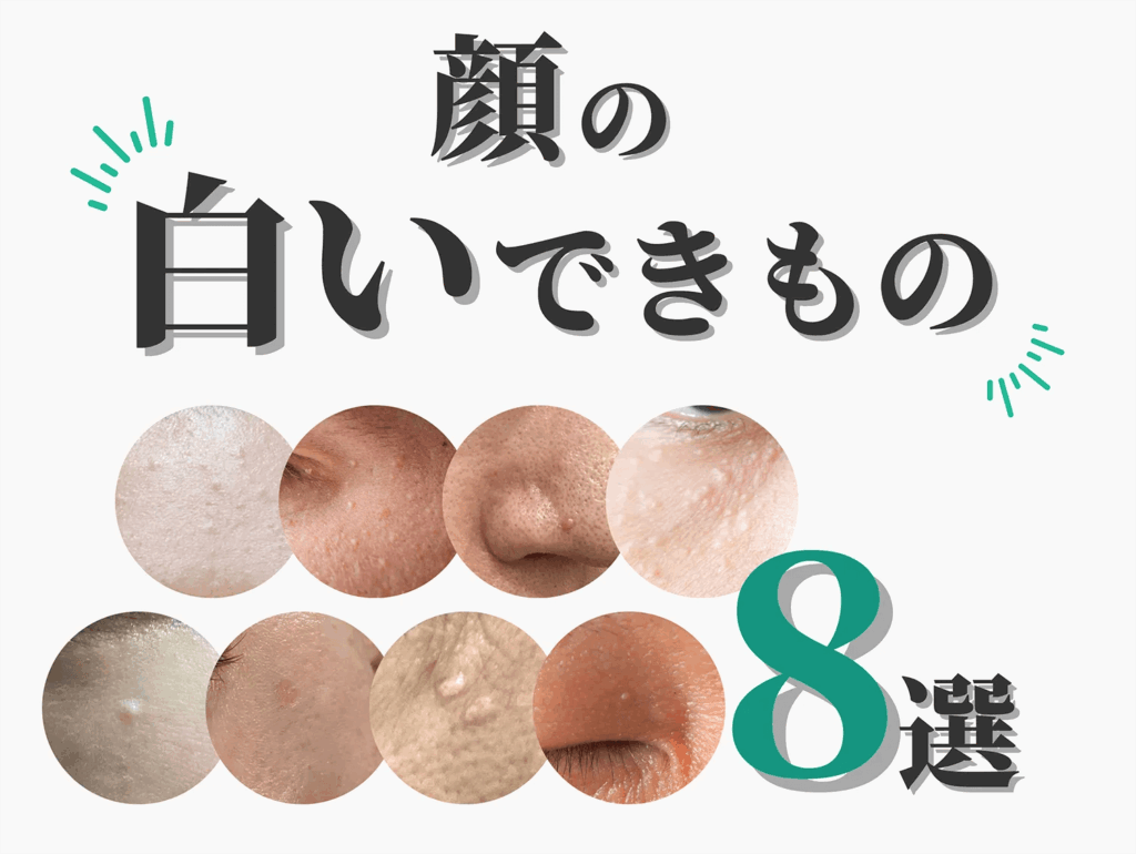 顔の白いイボの正体は？原因・種類・見分け方と治療法を皮膚科専門医が徹底解説【脂漏性角化症・稗粒腫・汗管腫など】