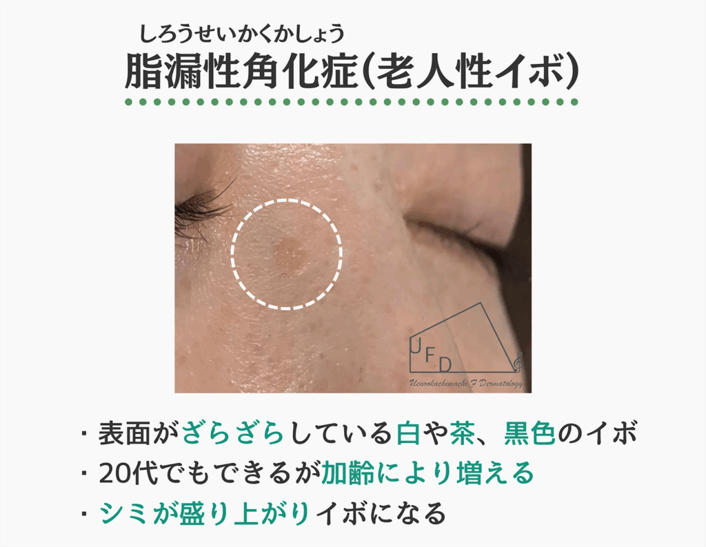 脂漏性角化症の症状写真　特徴や原因 治療法について解説