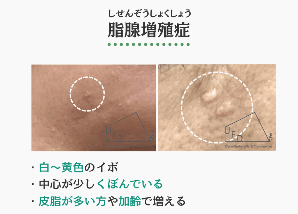 脂腺増殖症の症状写真　特徴や原因 治療法について解説
