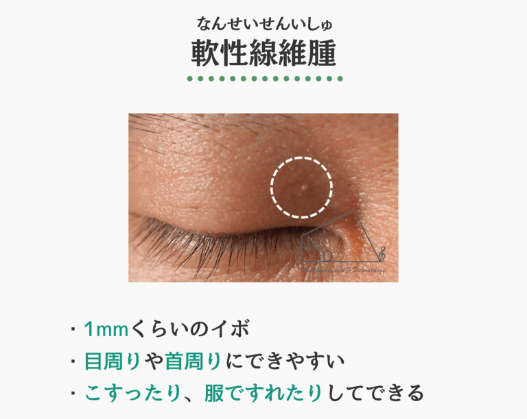 軟性線維腫の症状写真　特徴や原因 治療法について解説