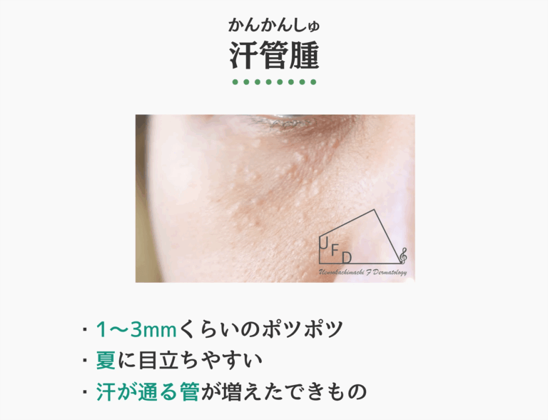 汗管腫の症状写真　特徴や原因 治療法について解説