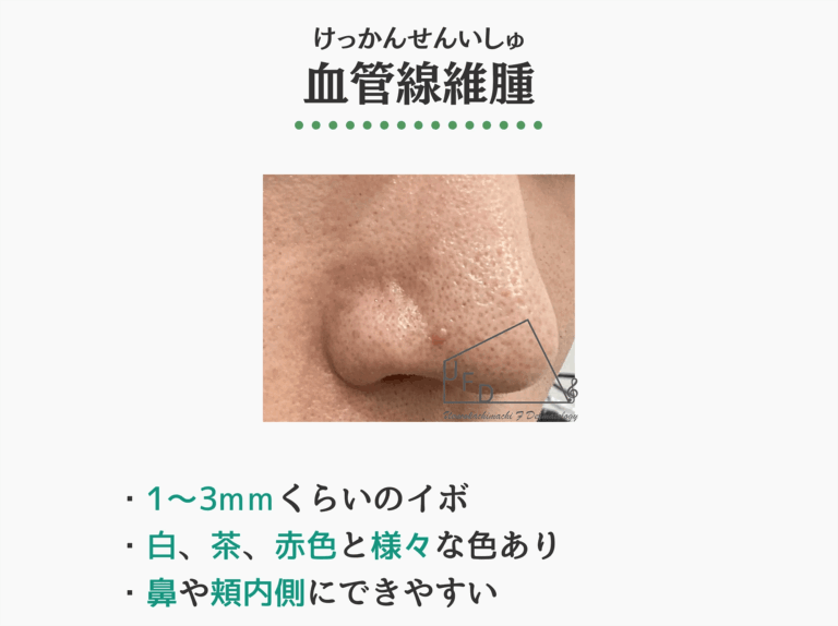 血管線維腫の症状写真　特徴や原因 治療法について解説