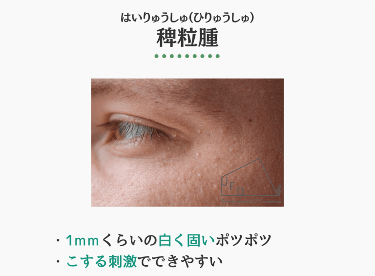 稗粒腫の症状写真　特徴や原因 治療法について解説