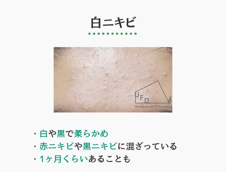白ニキビの症状写真　特徴や原因 治療法について解説