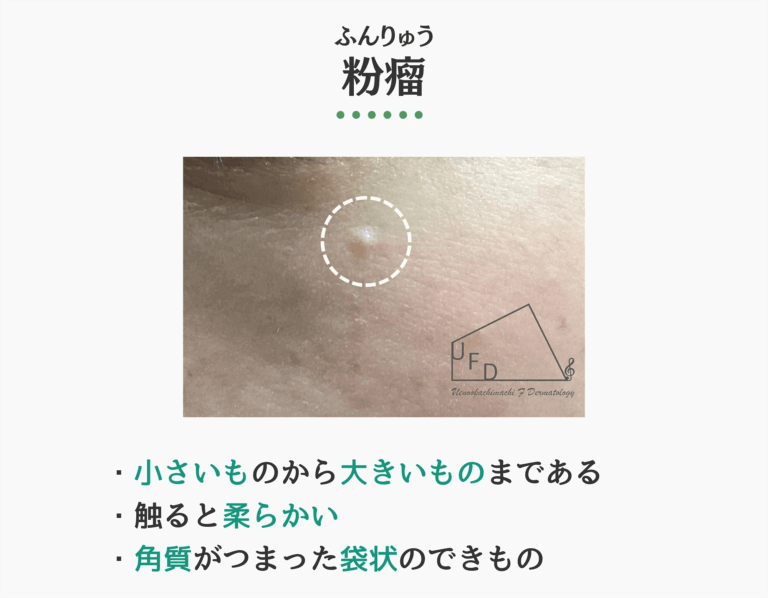 粉瘤の症状写真　特徴や原因 治療法について解説
