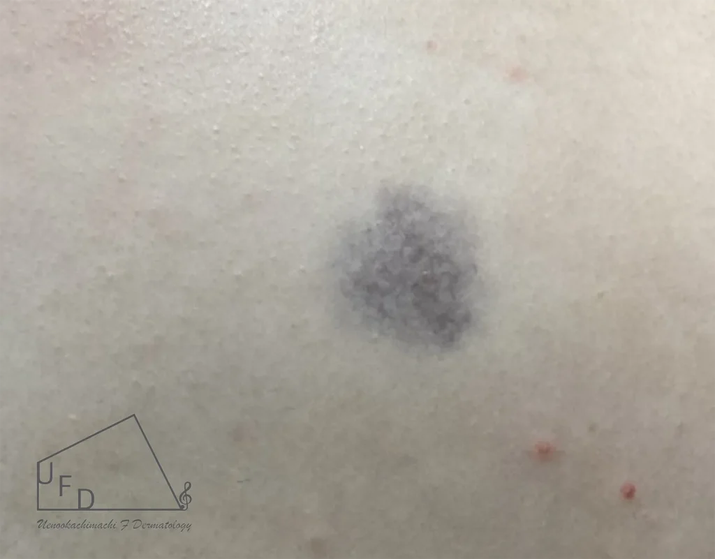 異所性蒙古斑の幹部写真とともに症状、治療方法を詳しく解説