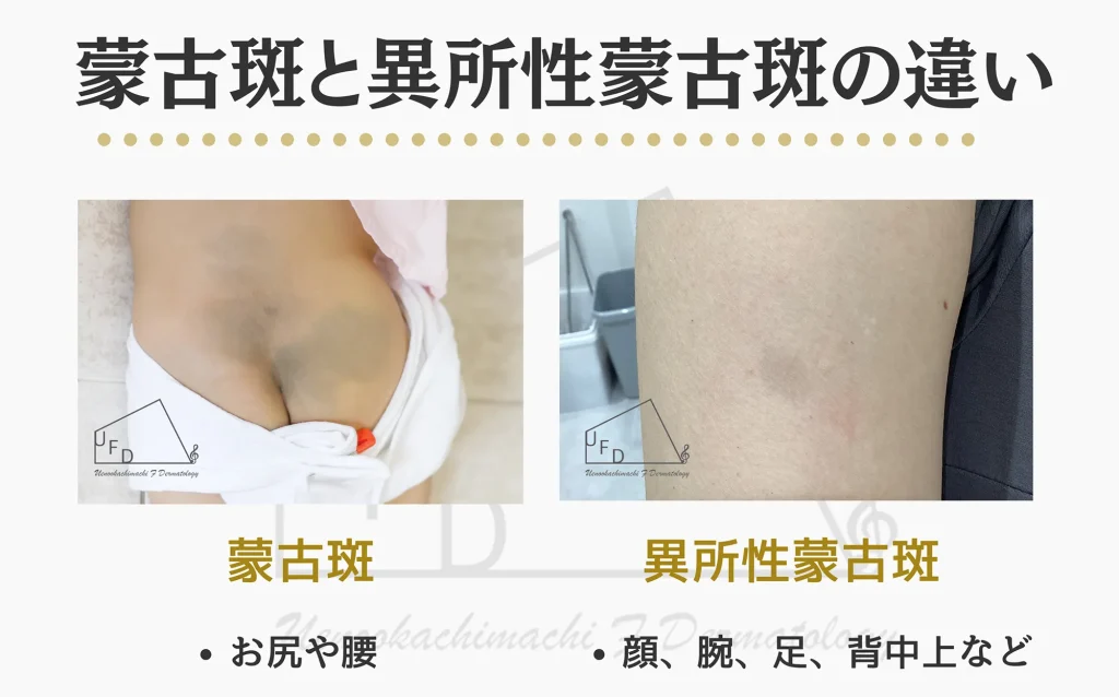 蒙古斑と異所性蒙古斑の違いを詳しく解説