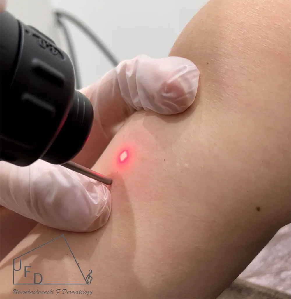 Qスイッチルビーレーザー治療による異所性蒙古斑の改善方法について解説