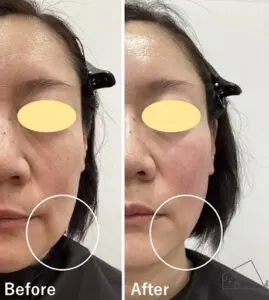 【40歳代女性】ほうれい線とマリオネットラインの改善(糸リフト実施)