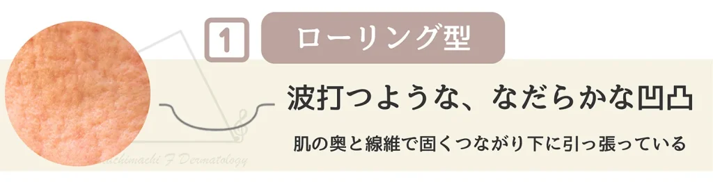 ニキビ跡の一種 ローリング型について特徴 原因 主訴を詳しく解説
