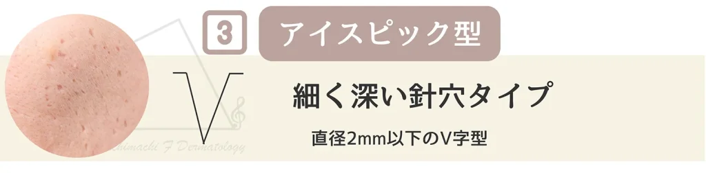 ニキビ跡の一種 アイスピック型について特徴 原因 主訴を詳しく解説